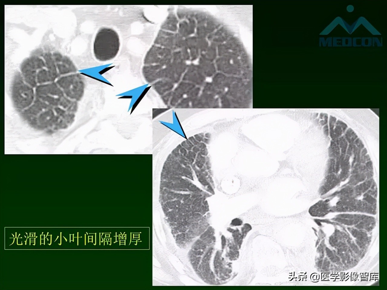 肺弥漫性网状影,两肺小叶间隔增厚可见网状模糊影