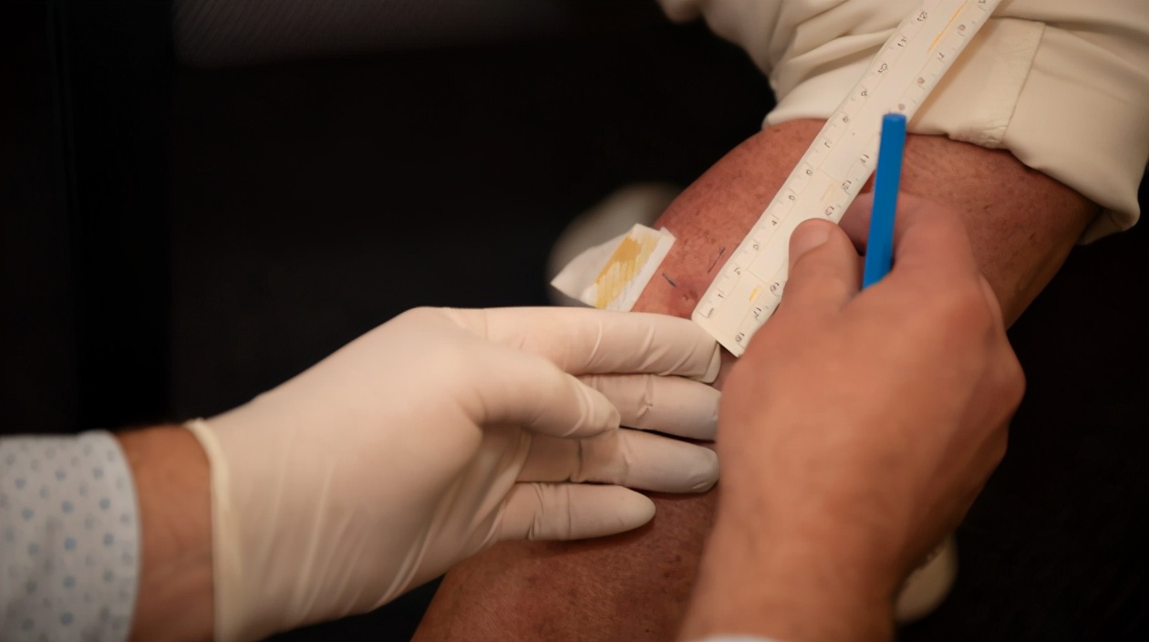 澳大利亚溃疡性结肠炎,澳大利亚皮肤溃疡