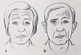 突发面瘫,突发面瘫治疗