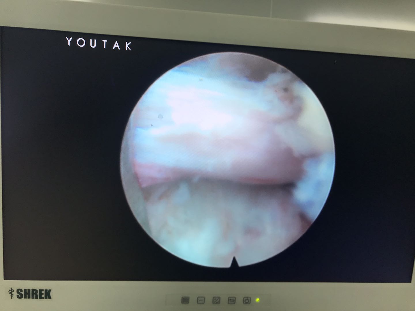 腰椎微创手术危险吗,腰椎微创手术有风险吗