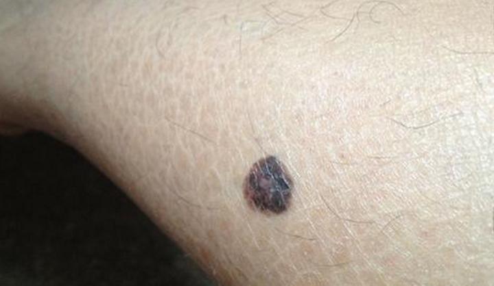 路边摆摊点痣用什么点痣,路边点痣真的可靠吗