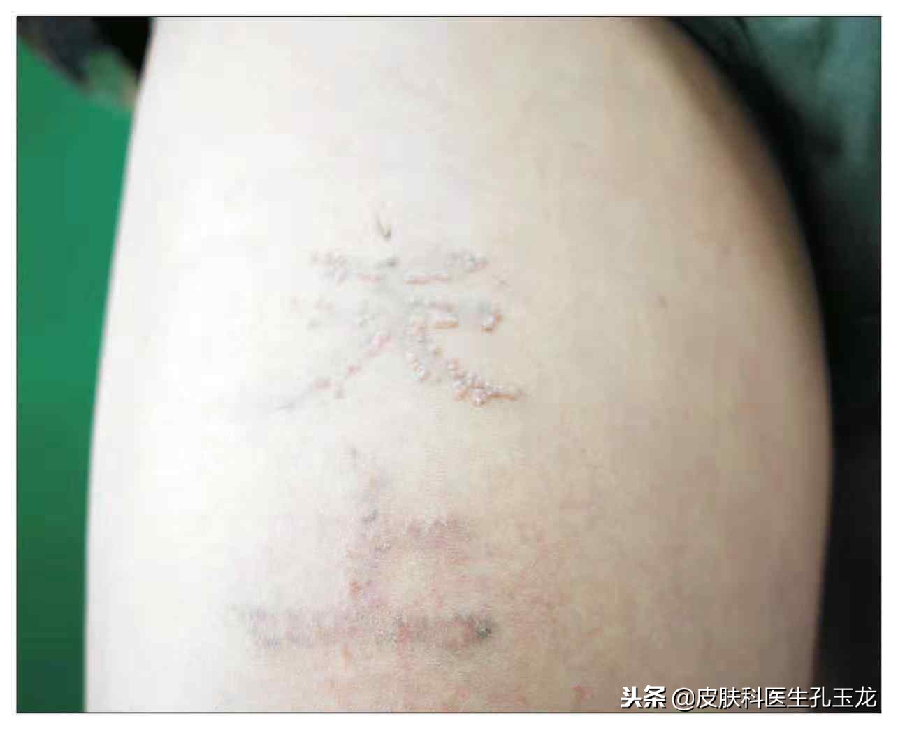 皮肤科疣有哪些,最常见的皮肤病扁平疣