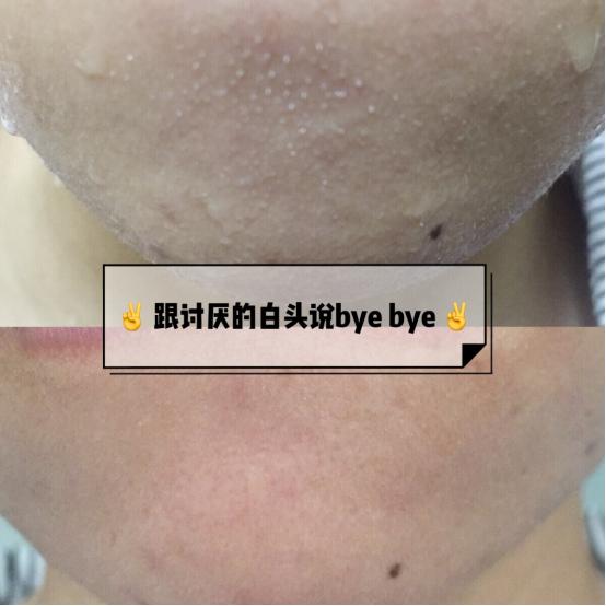 如何轻松去白头,一招去白头