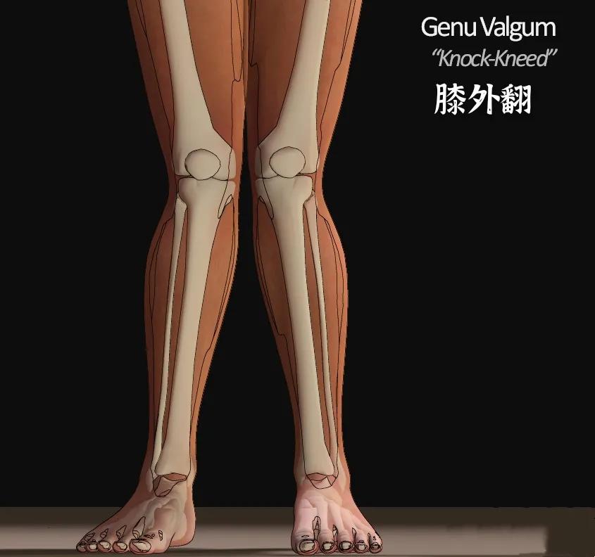 膝盖髌骨上下楼梯疼痛怎么办,髌骨外倾可以矫正过来吗