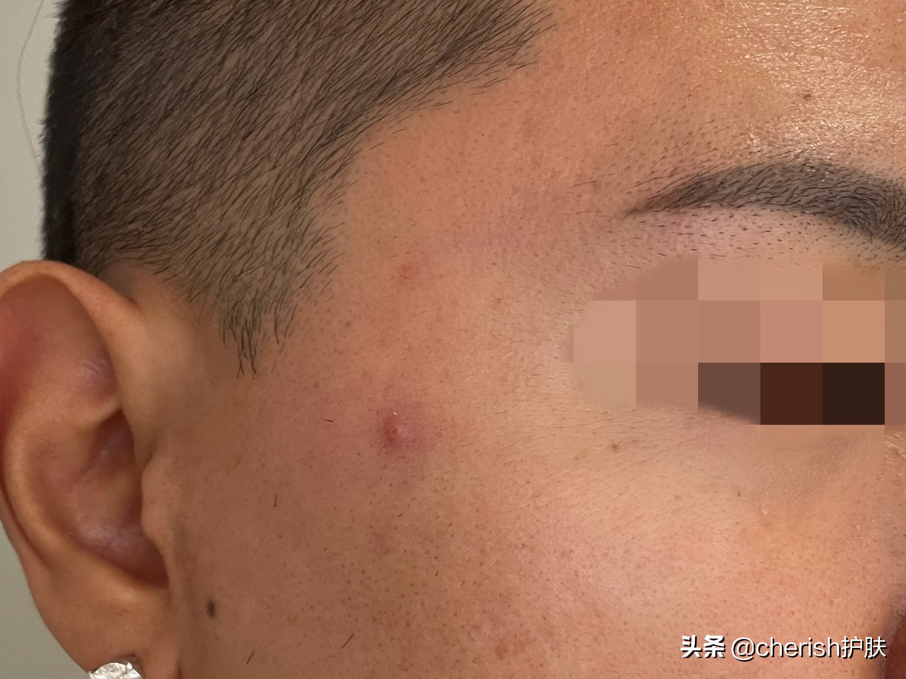 儿子额头上长了小红疙瘩,13岁男孩额头上长青春痘