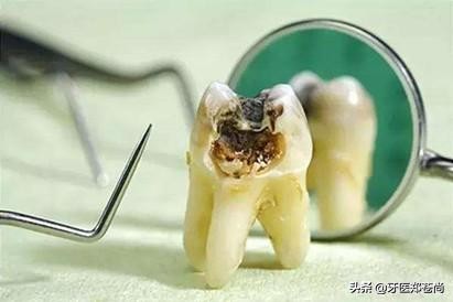 没形成牙洞前蛀牙可以自愈吗,严重蛀牙有个大洞怎么办