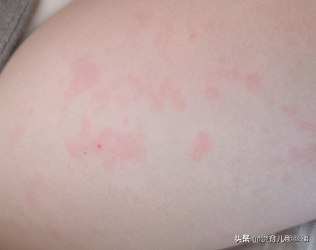 最奇葩的过敏图片,各种各样的过敏图片