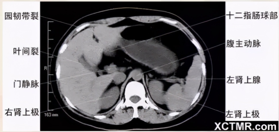 女性盆腔ct断层解剖结构图,女性盆腔脏器ct解剖