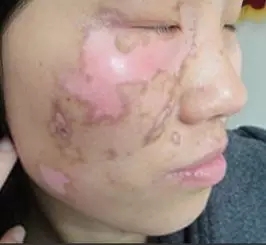 白癜风治疗之308nm准分子激光会出现的情况