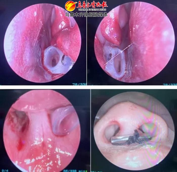 新生儿鼻腔闭锁怎么办,新生儿鼻孔堵塞呼吸不畅正常吗
