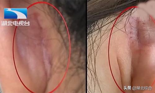 女子花三万多元隆鼻却失败,女子花5万隆鼻变畸形