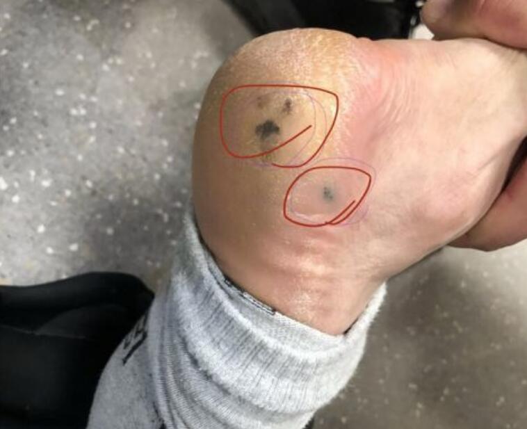脚底长黑痣会不会癌变啊,脚底板有黑痣的人