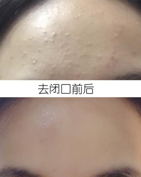 女生闭口粉刺怎么办,有闭口粉刺做什么医美