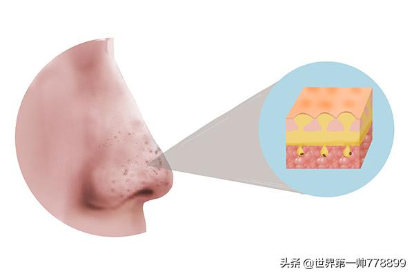 鼻子上挤出来的白色分泌物是什么,鼻子旁边挤出白色的分泌物是什么
