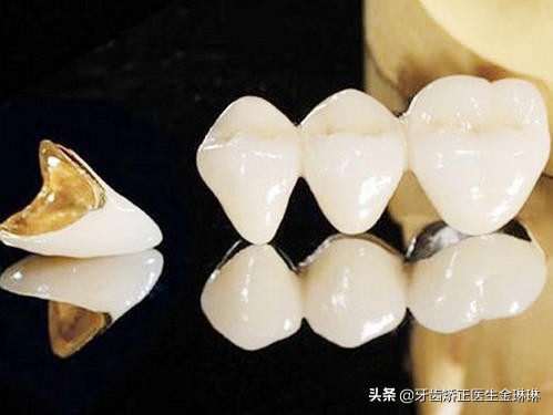 淄博烤瓷牙多少钱一个,淄博中心医院烤瓷牙