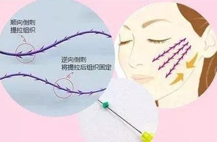 面部衰老除了线雕还可以做什么,线雕提升抗衰老