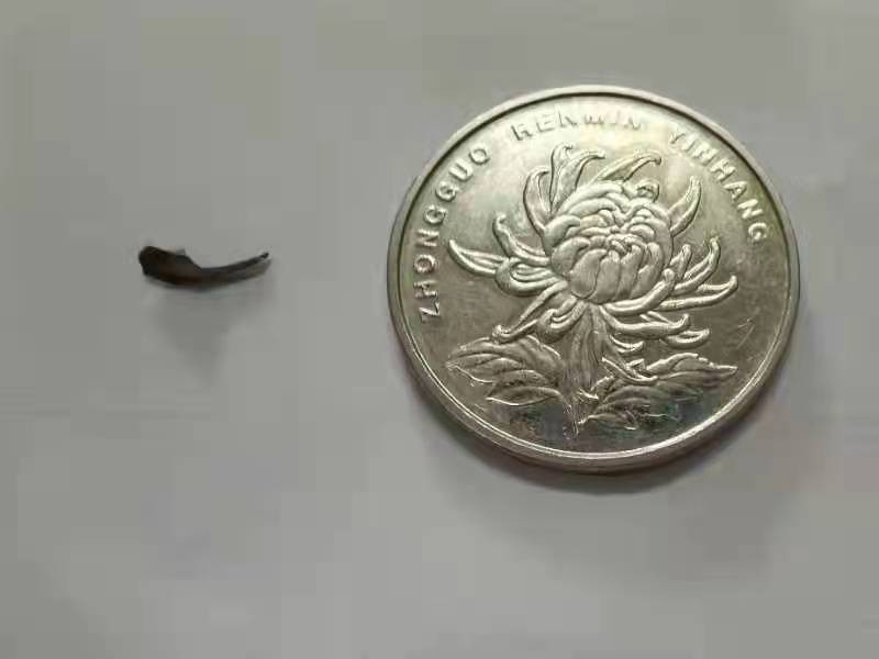 疼！电钻钻头蹦进眼里哈医大一院眼科专家用磁铁吸出近1厘米长的铁块…