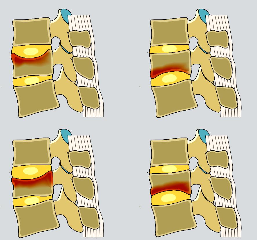 骨质疏松椎体压缩性骨折治疗指南,德国骨科骨质疏松骨折
