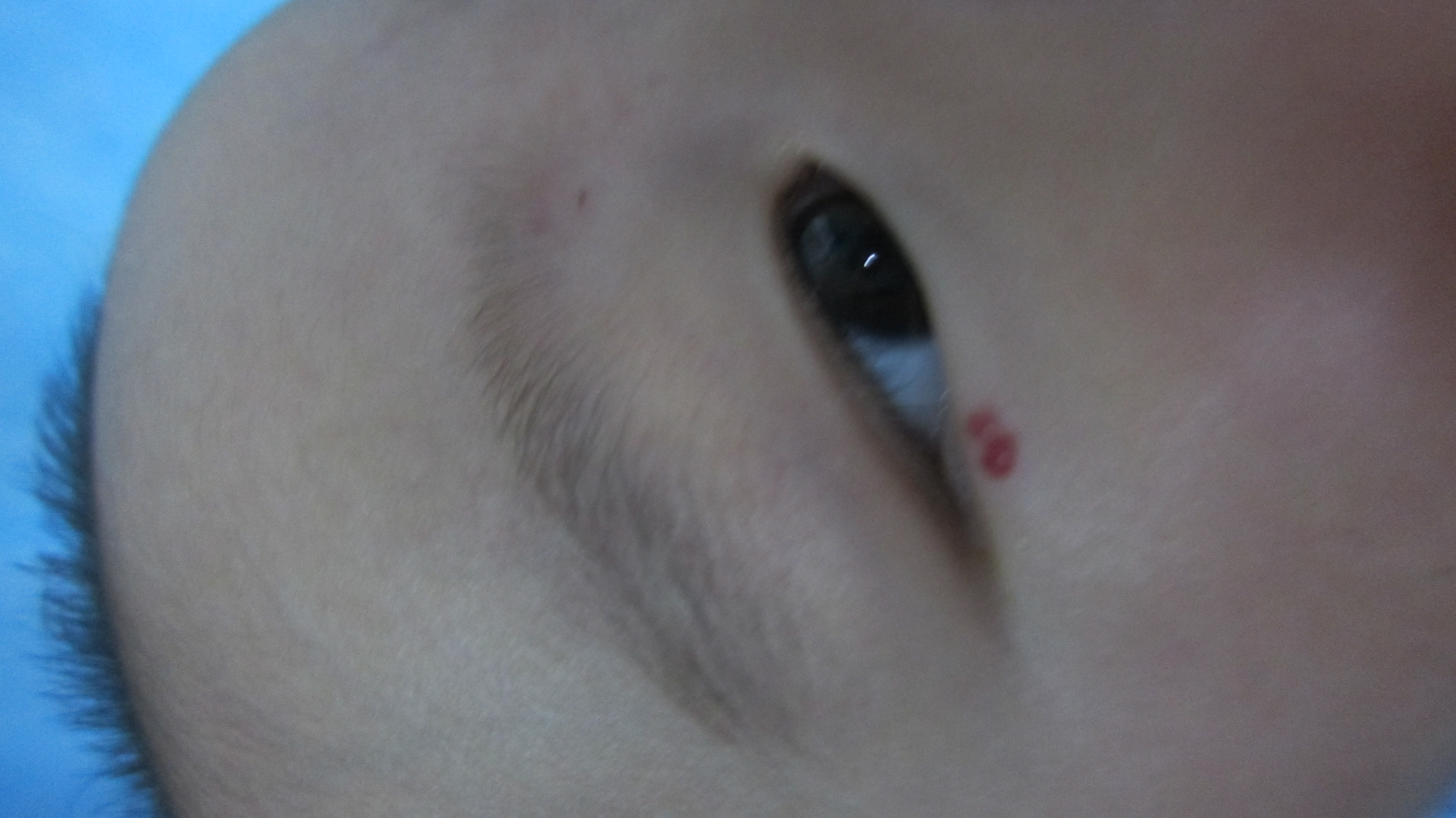 血管瘤注意事项和禁忌,血管瘤患者的饮食注意事项