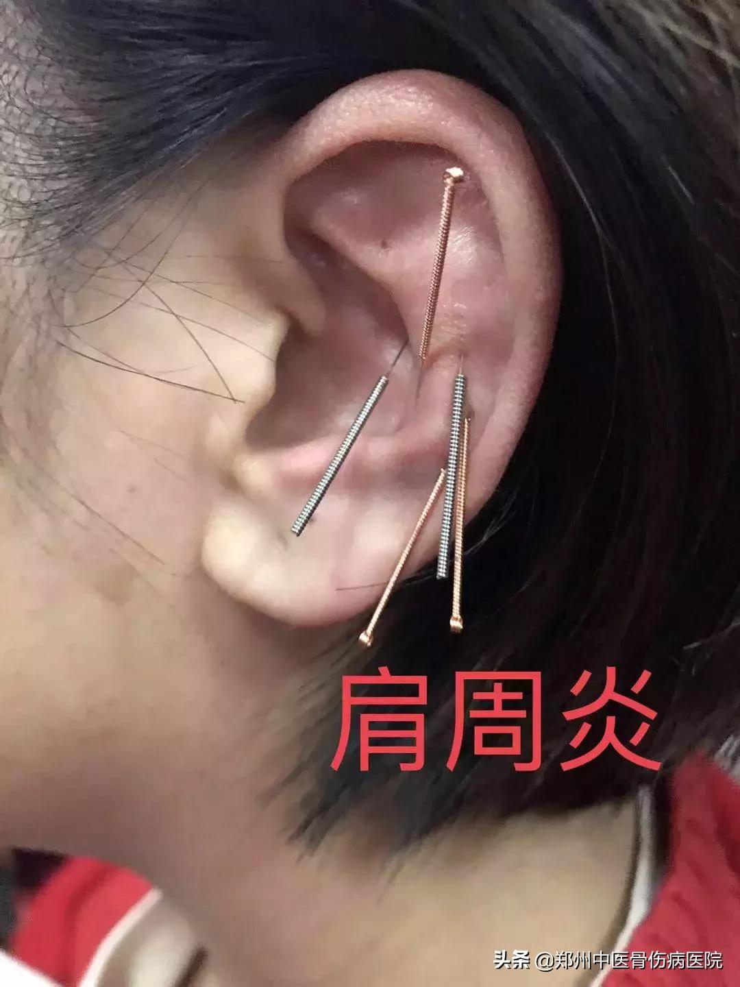 小耳朵大乾坤,耳穴的秘密中医