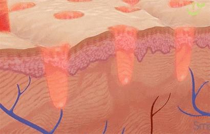 祛痘印小方法和步骤有哪些,痘印肌肤的护肤方法