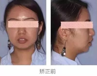 正畸主治学习视频,正畸钟摆效应名词解释