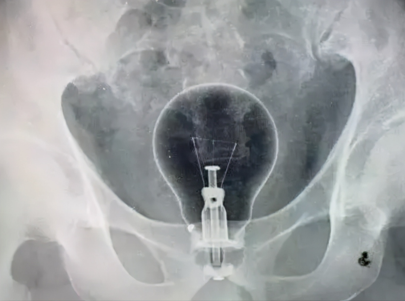 50cm“仙女管”插入少女胃里,这种自虐工具竟在淘宝卖疯了