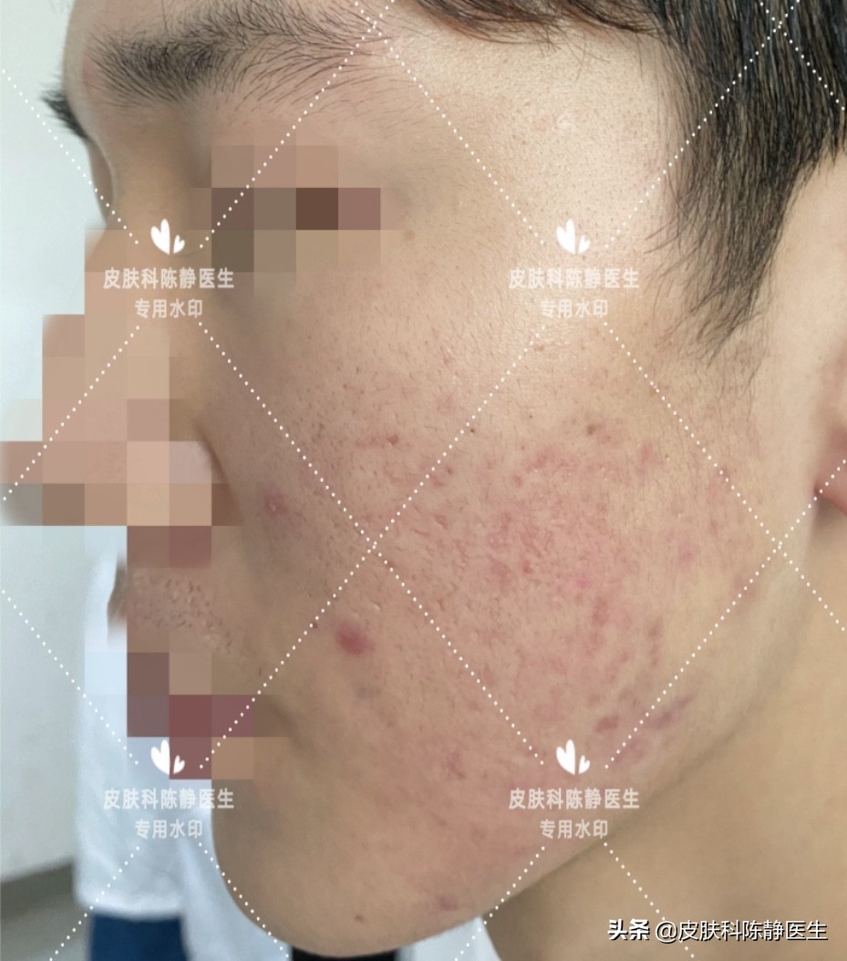 治疗脸部痤疮中医好还是西医好,传统治疗痤疮