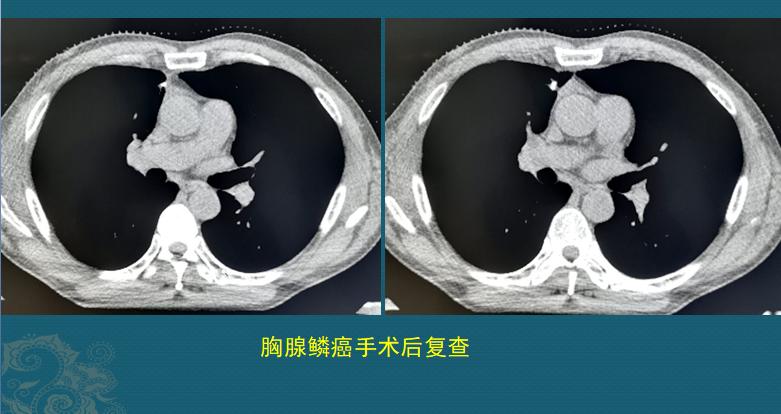 每年体检都做癌症筛查,每年一次体检能有效发现癌症吗