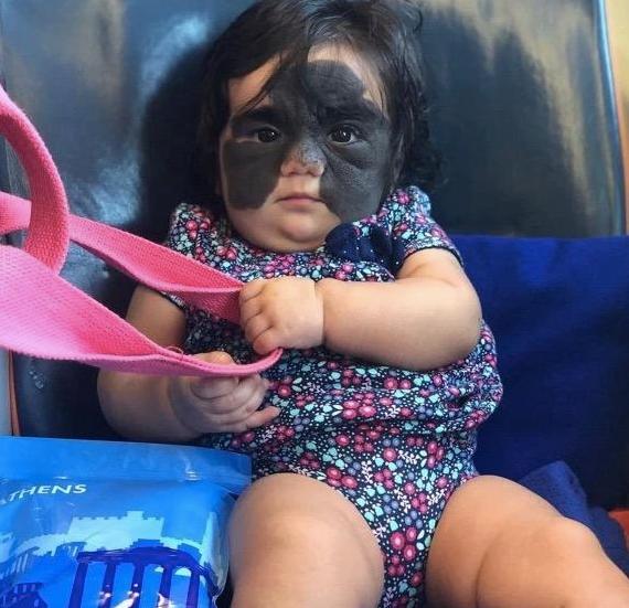 2岁女孩基因突变长得像80岁老人,2个孩子患罕见遗传病