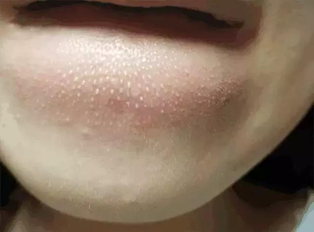 抿嘴时下巴密密麻麻小疙瘩,下巴长了好多凸起来的小疙瘩