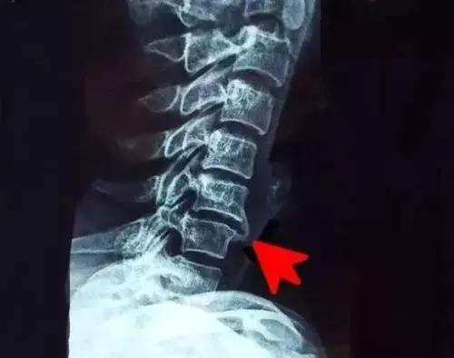 白术治骨刺的方法,脚底骨刺怎么治最快方法