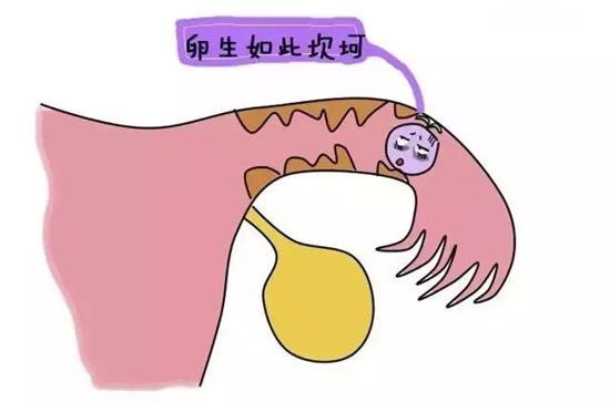 卵巢囊肿和卵巢冠囊肿有什么区别,卵巢巧克力囊肿和卵巢囊肿的区别