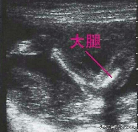 医生说孕妇宝宝腿短什么含义,孕晚期检查宝宝腿短意味着什么