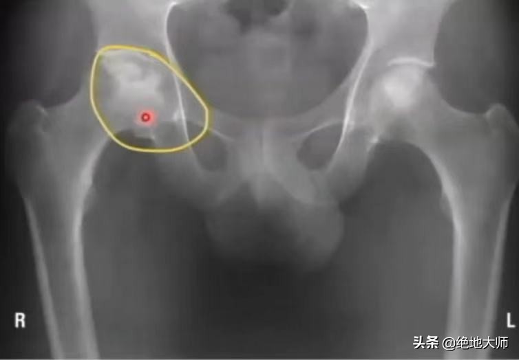 腿长短不一样怎么诊断,腿长短不一怎么调理