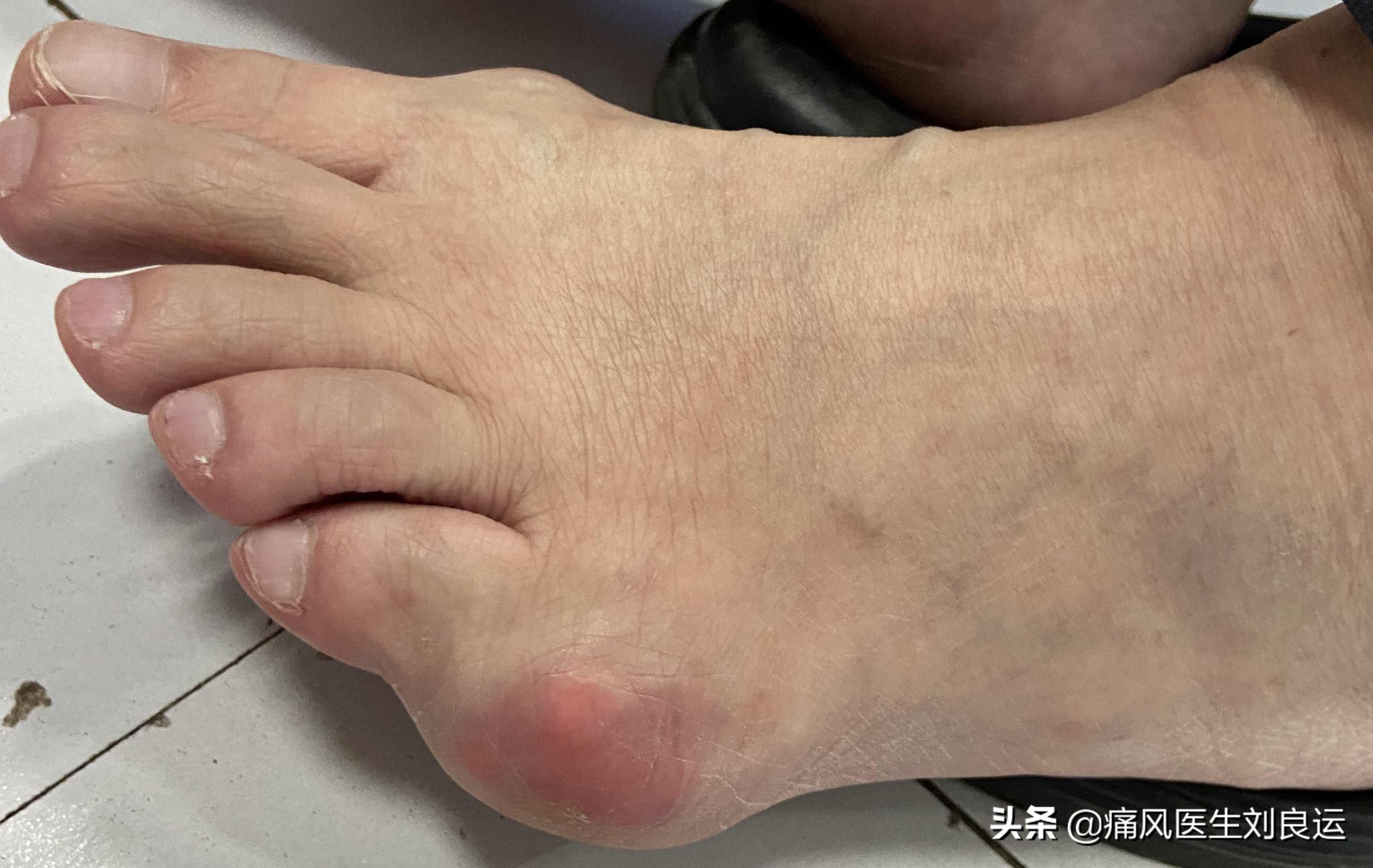 痛风医生建议不手术治疗,痛风尿酸高医生说不用吃药多喝水