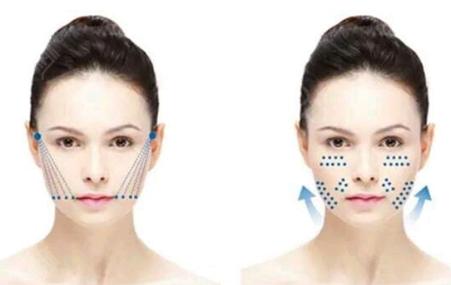 埋线面部提拉怎么样，做线雕能保持多久，不了解清楚还敢做？