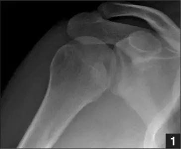 几种严重骨折医学名称,常见的骨折有哪些名称