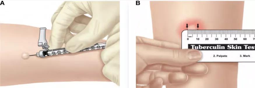 结核诊断方法和防治原则,结核的病原学诊断