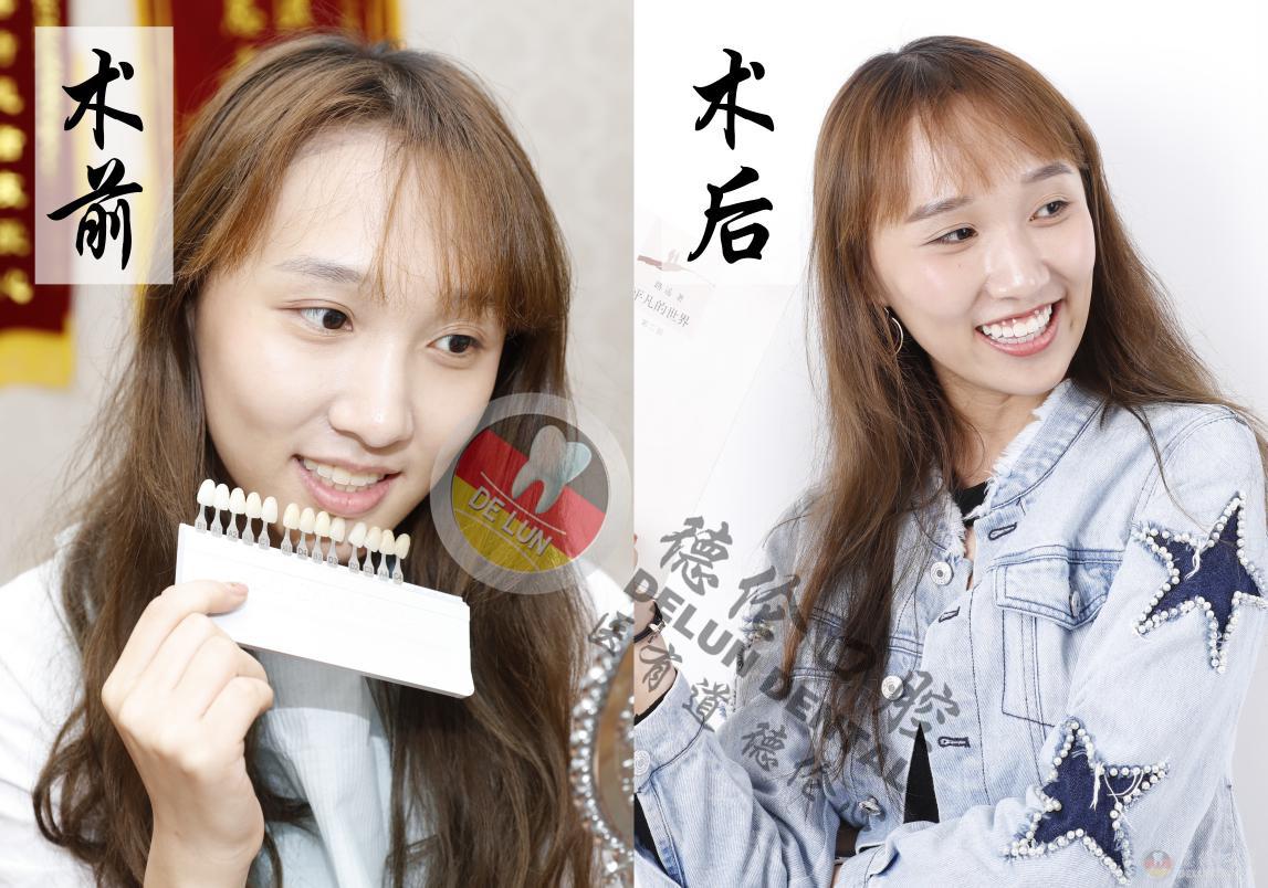 牙齿矫正有一颗倒了,牙齿矫正后又歪了谁负责