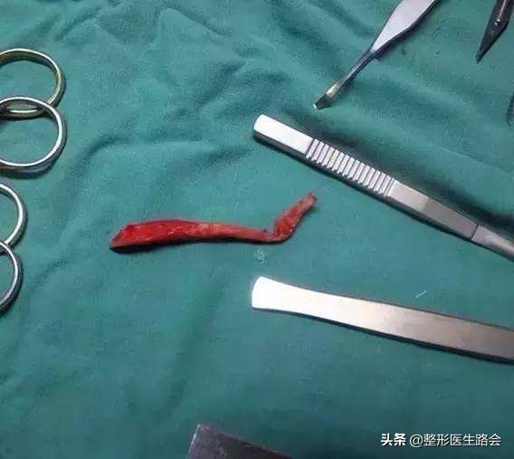 隆鼻后鼻尖发红按起疼怎么处理,隆鼻后鼻尖发紫是怎么回事