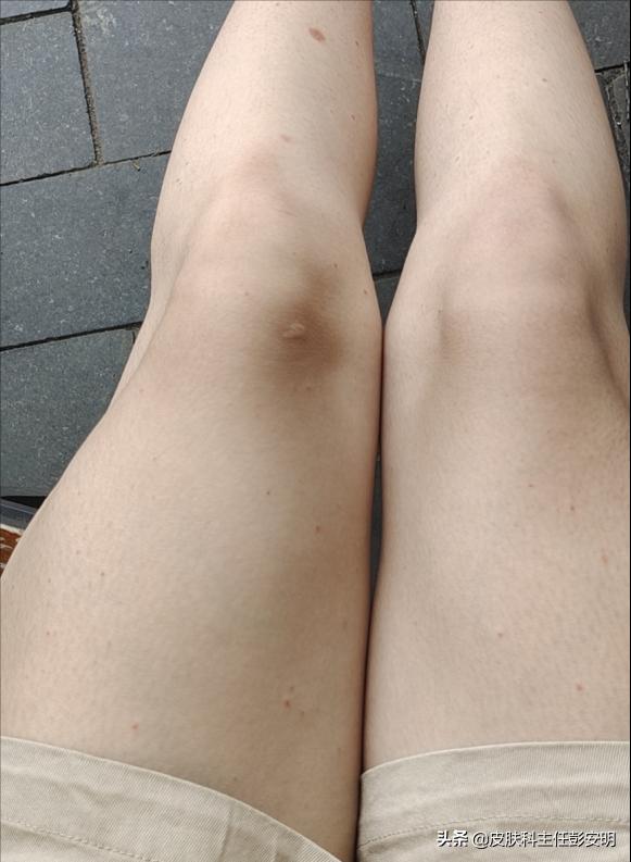 银屑病抗争经历,我与鱼鳞病的抗争