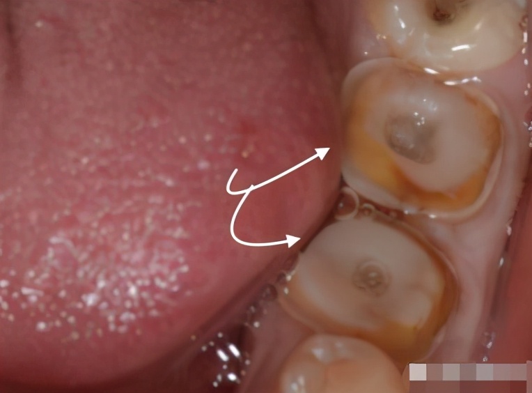 带牙冠里的牙齿烂掉了怎么办,戴的牙冠掉了发现牙根发黑