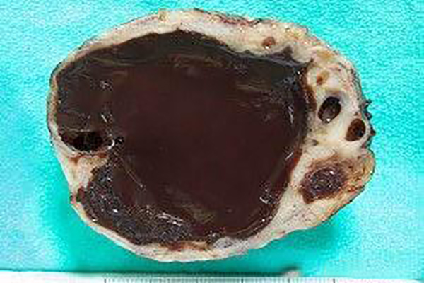 巧克力囊肿手术的利弊,巧克力囊肿的相关知识