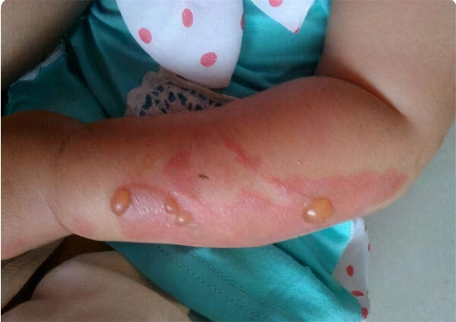 妈妈不小心被女孩烫伤,孩子被烫伤记住四件事情