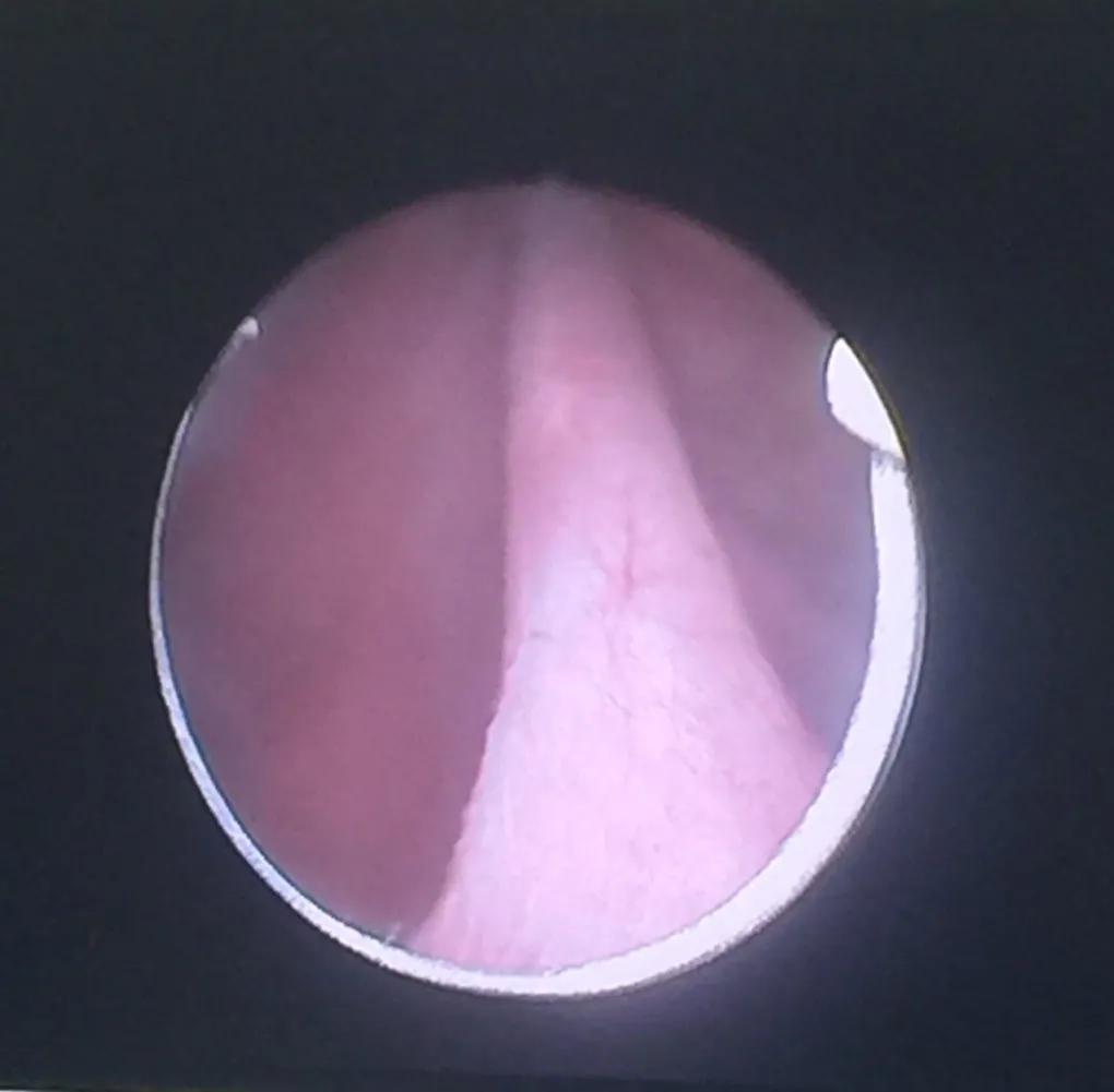 膀胱颈挛缩后尿道扩张几次痊愈,膀胱颈挛缩手术后可治愈