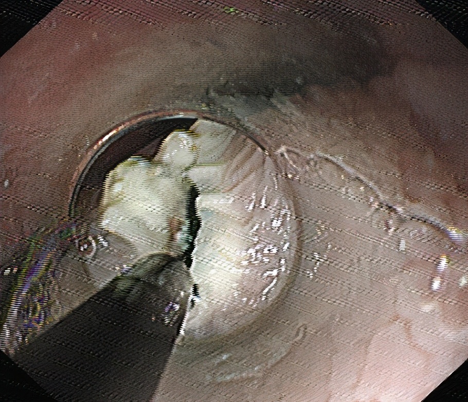 内镜下贲门失弛缓症微创手术,贲门失弛缓内镜治疗