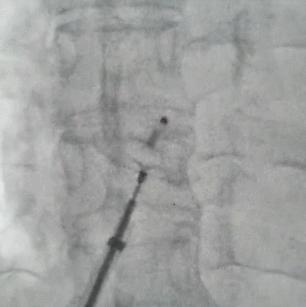 卵圆孔未闭封堵手术会脑血栓吗,心脏卵圆孔封堵术