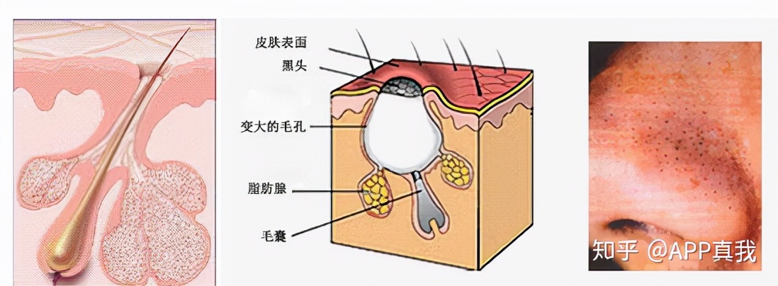 刷酸后黑头容易挤出来,刷酸后黑头多毛孔特别大了