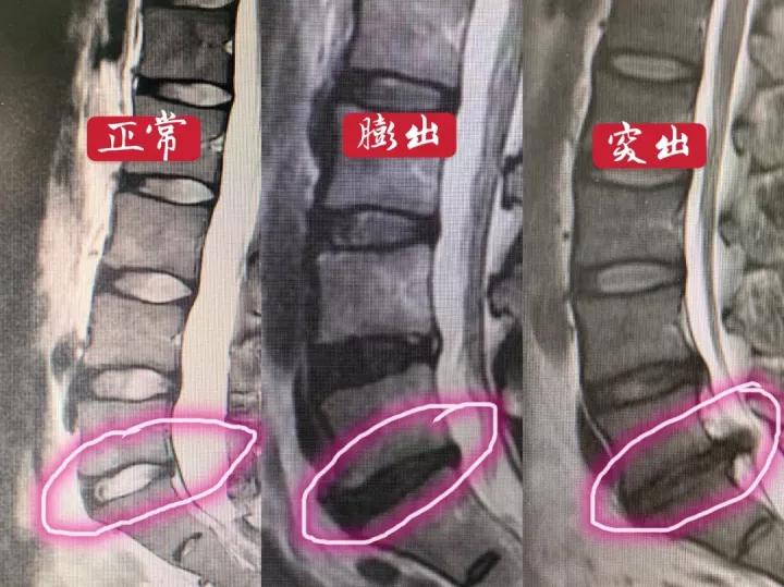 一文说清!腰椎间盘膨出、突出、脱出的区别,别再盲目开刀了